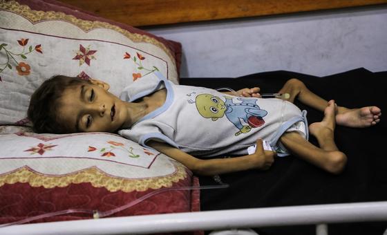 Gaza: Acute malnutrition among children hits record high
